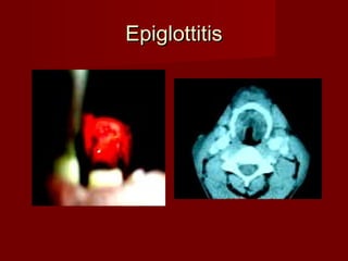 EpiglottitisEpiglottitis
 