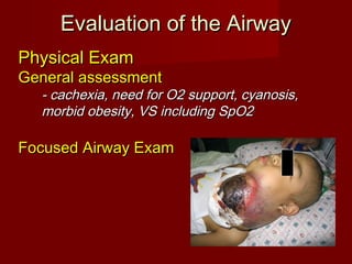 Evaluation of the AirwayEvaluation of the Airway
Physical ExamPhysical Exam
General assessmentGeneral assessment
- cachexia, need for O2 support, cyanosis,- cachexia, need for O2 support, cyanosis,
morbid obesity, VS including SpO2morbid obesity, VS including SpO2
Focused Airway ExamFocused Airway Exam
 
