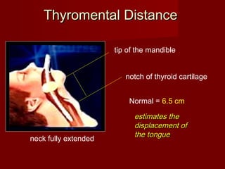 Thyromental DistanceThyromental Distance
estimates theestimates the
displacement ofdisplacement of
the tonguethe tongue
notch of thyroid cartilage
tip of the mandible
Normal = 6.5 cm
neck fully extended
 