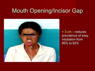 Mouth Opening/Incisor GapMouth Opening/Incisor Gap
< 3 cm< 3 cm – reduces– reduces
prevalence of easyprevalence of easy
intubation fromintubation from
95% to 62%95% to 62%
 