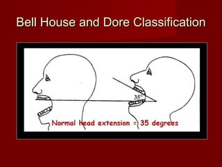 Bell House and Dore ClassificationBell House and Dore Classification
 