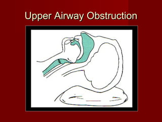 Upper Airway ObstructionUpper Airway Obstruction
 