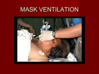 MASK VENTILATIONMASK VENTILATION
 