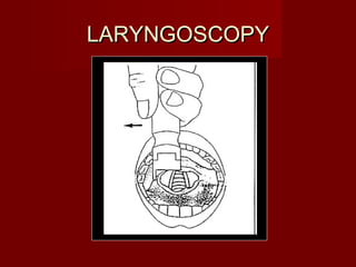 LARYNGOSCOPYLARYNGOSCOPY
 