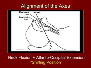 Alignment of the AxesAlignment of the Axes
Neck Flexion + Atlanto-Occipital Extension
“Sniffing Position”
 