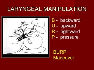 LARYNGEAL MANIPULATIONLARYNGEAL MANIPULATION
B - backward
U - upward
R - rightward
P - pressure
BURP
Maneuver
 