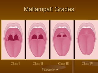 Mallampati Grades    Difficulty    Class I   Class II   Class III   Class IV 