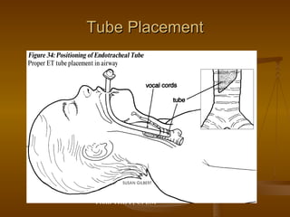 Tube Placement From TRIPP, CPEM 