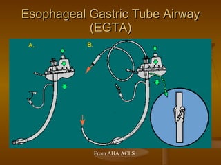 Esophageal Gastric Tube Airway (EGTA) From AHA ACLS 