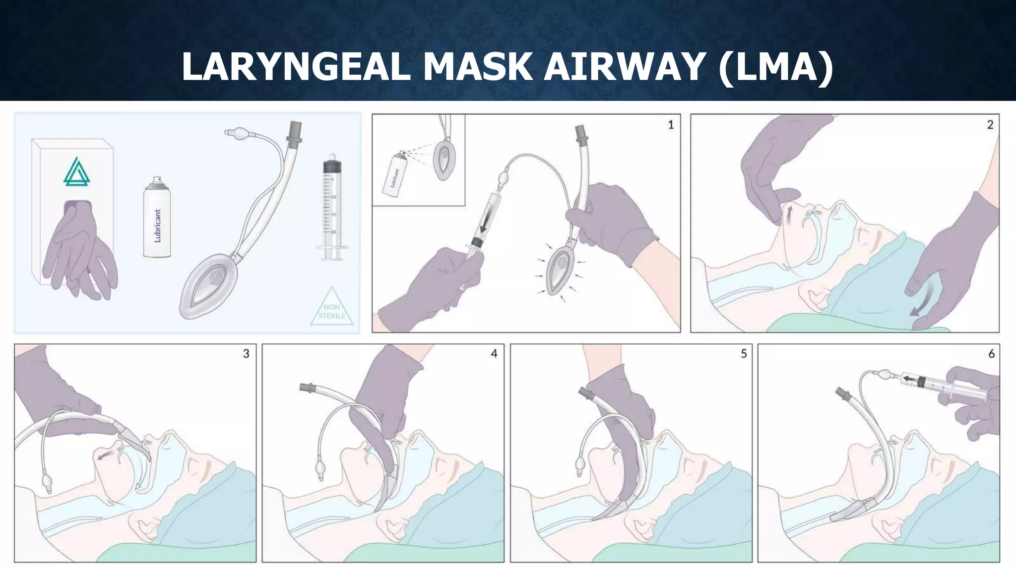 LARYNGEAL MASK AIRWAY (LMA)
 