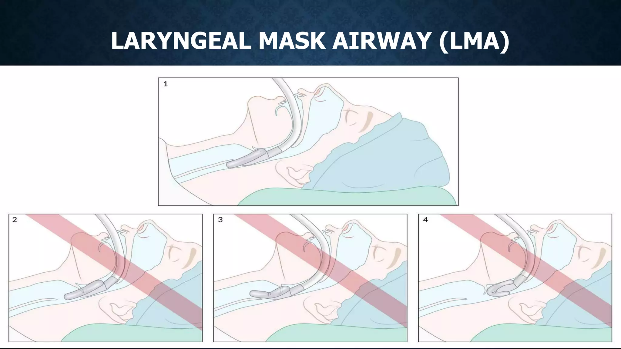 LARYNGEAL MASK AIRWAY (LMA)
 