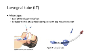 Laryngeal tube (LT)
• Advantages:
• Ease of training and insertion
• Reduces the risk of aspiration compared with bag-mask ventilation
 