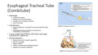 Esophageal-Tracheal Tube
(Combitube)
• Advantage
• Isolates the airway
• Reduces the risk of aspiration
• Provides more reliable ventilation
• Ease of training
• Complication :
• Fatal complication is possible if incorrectly identify distal
lumen
• Esophageal trauma: laceration, bruising, and
subcutaneous emphysema
• 2 sizes: smaller size (37F) for 120-155cm tall, larger
size (41F) for >150cm tall
• Contraindications
• Responsive pt with cough or gag reflex
• Age 16 or younger
• Height <120cm
• Known or suspected esophageal disease
• Ingestion of a caustic substance
 
