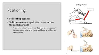 Positioning
• Full sniffing position
• Sellick maneuver – application pressure over
the cricoid cartilage
• It is not routinely recommended coz esophagus can
be positioned lateral to the cricoid ring and thus be
exaggerated
 