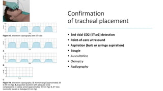 Confirmation
of tracheal placement
 End tidal CO2 (ETco2) detection
 Point-of-care ultrasound
 Aspiration (bulb or syringe aspiration)
 Bougie
 Auscultation
 Oximetry
 Radiography
 