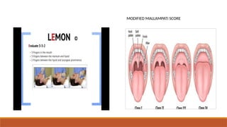 airway management in Anesthesia for intubation | PPTX