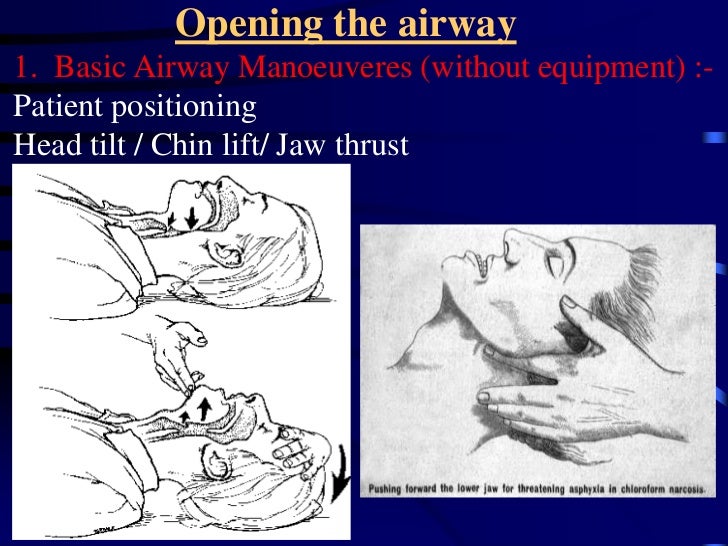 Airway management
