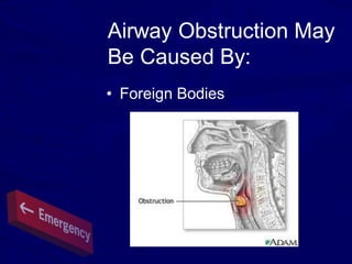 Airway Obstruction May
Be Caused By:
• Foreign Bodies
 