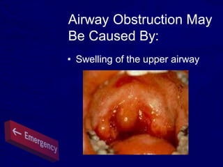Airway Obstruction May
Be Caused By:
• Swelling of the upper airway
 