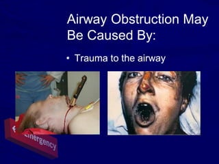 Airway Obstruction May
Be Caused By:
• Trauma to the airway
 