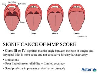 SIGNIFICANCE OF MMP SCORE
• Class III or IV: signiﬁes that the angle between the base of tongue and
laryngeal inlet is more acute and not conducive for easy laryngoscopy
• Limitations 
– Poor interobserver reliability – Limited accuracy
• Good predictor in pregnancy, obesity, acromegaly
 
