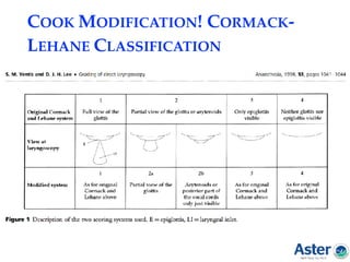 COOK MODIFICATION! CORMACK-
LEHANE CLASSIFICATION
 