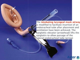 The intubating laryngeal mask airway
is modiﬁed to facilitate insertion of an
endotracheal tube after placement and
ventilation have been achieved. The
epiglottic elevator (arrowhead) lifts the
epiglottis to allow passage of the
special endotracheal tube (arrow)
 
