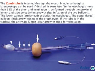 The Combitube is inserted through the mouth blindly, although a
laryngoscope can be used if desired. It seats itself in the esophagus more
than 95% of the time, and ventilation is performed through the proximal
lumen and side ports (white arrows) after inﬂation of the two balloons.
The lower balloon (arrowhead) occludes the esophagus. The upper (large)
balloon (thick arrow) occludes the oropharynx. If the tube is in the
trachea, the alternate lumen (clear arrow) is used for ventilation.
 
