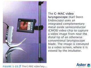 The C-MAC video
laryngoscope (Karl Storz
Endoscopy) uses an
integrated complementary
metal oxide semiconductor
(CMOS) video chip to capture
a video image from near the
distal tip of an otherwise
conventional laryngoscope
blade. The image is conveyed
to a video screen, where it is
viewed by the intubator.
 