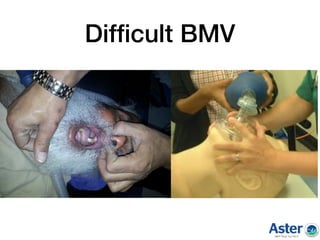Difﬁcult BMV
 