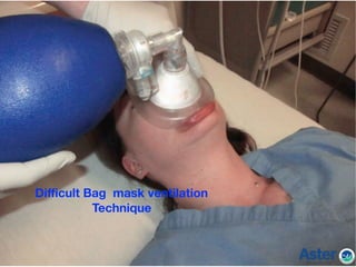 Diﬃcult Bag mask ventilation
Technique
 