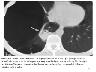100
Atelectatic pseudomass. Computed tomography demonstrates a right paraspinal mass
(arrow) with central air bronchograms. A very large bulla almost completely fills the right
hemithorax. The mass represented collapsed normal lung that re-expanded following
resection of the bulla.
 