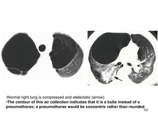 101
•Normal right lung is compressed and atelectatic (arrow).
•The contour of this air collection indicates that it is a bulla instead of a
pneumothorax; a pneumothorax would be concentric rather than rounded.
 