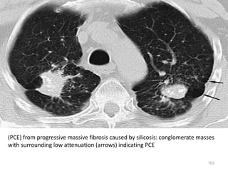 103
(PCE) from progressive massive fibrosis caused by silicosis: conglomerate masses
with surrounding low attenuation (arrows) indicating PCE
 