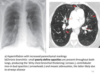 106
a) Hyperinflation with increased parenchymal markings
b)Chronic bronchitis small poorly define opacities are present throughout both
lungs, producing the 'dirty chest bronchial thickening ( arrows ), centrilobular
tree-in-bud opacities ( arrowheads ) and mosaic attenuation, the latter likely due
to airways disease
 