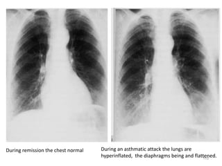 110
During remission the chest normal During an asthmatic attack the lungs are
hyperinflated, the diaphragms being and flattened.
 