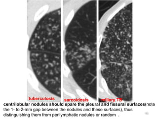 115
centrilobular nodules should spare the pleural and fissural surfaces(note
the 1- to 2-mm gap between the nodules and these surfaces), thus
distinguishing them from perilymphatic nodules or random .
miliary TBsarcoidosistuberculosis
 
