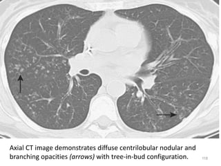 118
Axial CT image demonstrates diffuse centrilobular nodular and
branching opacities (arrows) with tree-in-bud configuration.
 
