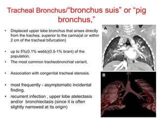 12
Tracheal Bronchus/“bronchus suis” or “pig
bronchus,”
• Displaced upper lobe bronchus that arises directly
from the trachea, superior to the carina(at or within
2 cm of the tracheal bifurcation)
• up to 5%(0.1% webb)(0.5-1% brant) of the
population.
• The most common tracheobronchial variant.
• Association with congenital tracheal stenosis.
• most frequently - asymptomatic incidental
finding.
• recurrent infection , upper lobe atelectasis
and/or bronchiectasis (since it is often
slightly narrowed at its origin)
 