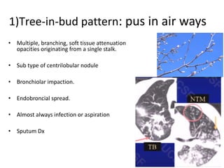 120
1)Tree-in-bud pattern: pus in air ways
• Multiple, branching, soft tissue attenuation
opacities originating from a single stalk.
• Sub type of centrilobular nodule
• Bronchiolar impaction.
• Endobroncial spread.
• Almost always infection or aspiration
• Sputum Dx
 