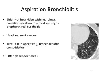 122
Aspiration Bronchiolitis
• Elderly or bedridden with neurologic
conditions or dementia predisposing to
oropharyngeal dysphagia.
• Head and neck cancer
• Tree-in-bud opacities + bronchocentric
consolidation.
• Often dependent areas.
 