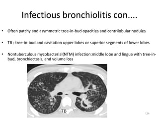 124
Infectious bronchiolitis con....
• Often patchy and asymmetric tree-in-bud opacities and centrilobular nodules
• TB : tree-in-bud and cavitation upper lobes or superior segments of lower lobes
• Nontuberculous mycobacterial(NTM) infection:middle lobe and lingua with tree-in-
bud, bronchiectasis, and volume loss
TB
 