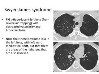 131
Swyer-James syndrome
• FIG :-Hyperlucent left lung (from
severe air trapping) with
decreased vascularity and
bronchiectasis.
• Note that there is volume loss in
the left lung, with left ward
mediastinal shift, but that there
are areas of the right lung that
are also involved.
 