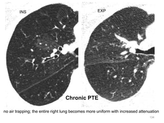 134
no air trapping; the entire right lung becomes more uniform with increased attenuation
INS EXP
Chronic PTE
 