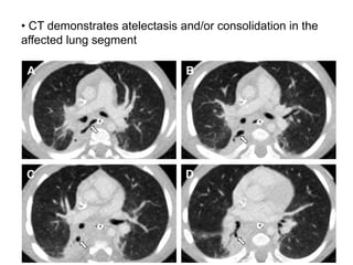 14
• CT demonstrates atelectasis and/or consolidation in the
affected lung segment
 