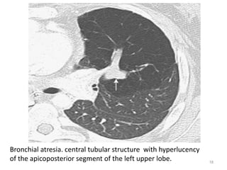18
Bronchial atresia. central tubular structure with hyperlucency
of the apicoposterior segment of the left upper lobe.
 