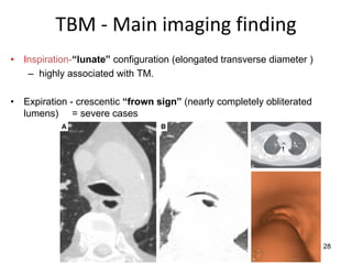 28
TBM - Main imaging finding
• Inspiration-“lunate” configuration (elongated transverse diameter )
– highly associated with TM.
• Expiration - crescentic “frown sign” (nearly completely obliterated
lumens) = severe cases
 