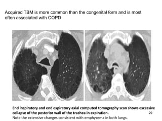 29
Acquired TBM is more common than the congenital form and is most
often associated with COPD
End inspiratory and end expiratory axial computed tomography scan shows excessive
collapse of the posterior wall of the trachea in expiration.
Note the extensive changes consistent with emphysema in both lungs.
 