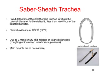 30
Saber-Sheath Trachea
• Fixed deformity of the intrathoracic trachea in which the
coronal diameter is diminished to less than two-thirds of the
sagittal diameter.
• Clinical evidence of COPD ( 95%)
• Due to Chronic injury and malacia of tracheal cartilage
(coughing or increased intrathoracic pressure).
• Main bronchi are of normal size.
 