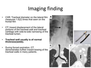 31
• CXR: Tracheal diameter on the lateral film
measures 1.5(2) times that seen on the
frontal film
• CT: Inward displacement of the lateral
portions of the tracheal wall and tracheal
cartilage with side-to-side narrowing of the
tracheal lumen.
• Tracheal wall usually is of normal
thickness(webb).
• During forced expiration, CT
demonstrates further inward bowing of the
tracheal walls in many patients.
Imaging finding
 